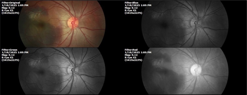 The photograph of the fundus of the right eye shows significant subretinal bleeding, which affects the entire macular area; and some blood is also seen in the vitreous body.