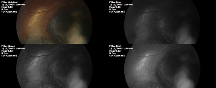 The extent of bleeding, mainly subretinal, is extensive and of significant volume, suggesting choroid rupture in this area.